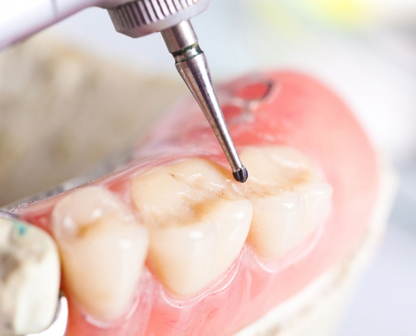 Dental Filling Bardia Dental Care